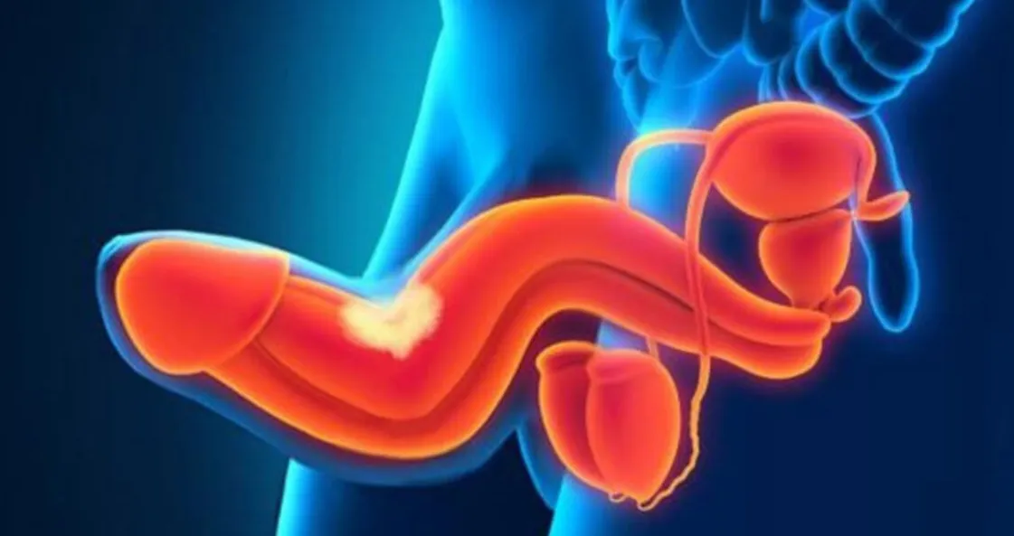 indurimento plastico del pene
